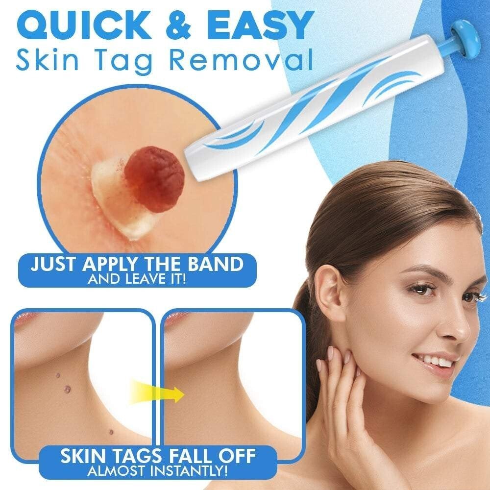 CircuLuxe™ — Pain-Free Skin Tag Removal for Instant Confidence and Clear, Radiant Skin