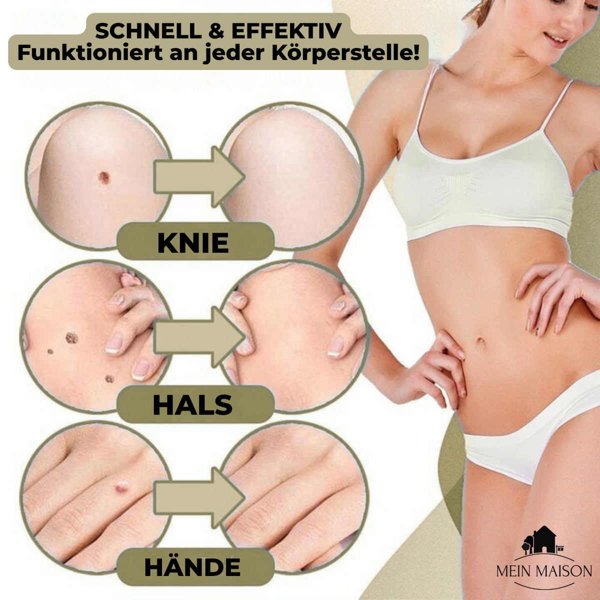 Skin Treatment for Wart and Mole Removal at Home Without Pain
