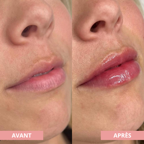 Arvilaro | Kit Ritual Lips - Thicker & Shiny lips in minutes