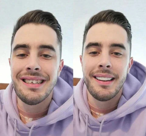 Transform Your Smile Instantly with Custom Fit Veneers
