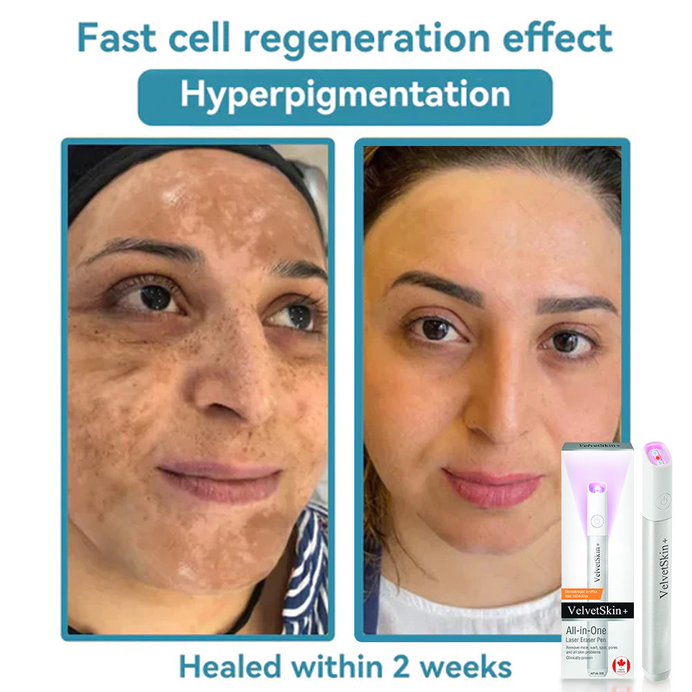 CO₂ Technology Laser Pen for Treating Skin Imperfections