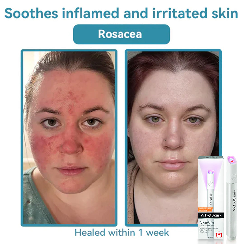 CO₂ Technology Laser Pen for Treating Skin Imperfections
