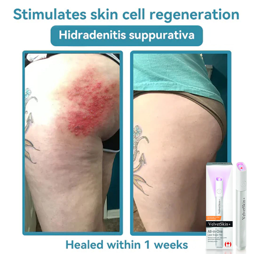CO₂ Technology Laser Pen for Treating Skin Imperfections