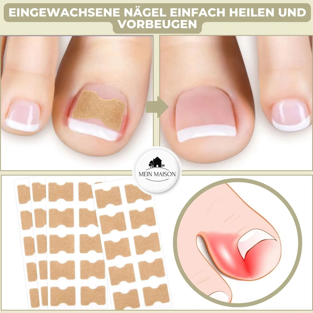 Nail Correction Patches Elastic Fabric Peel-and-Stick 20 Count