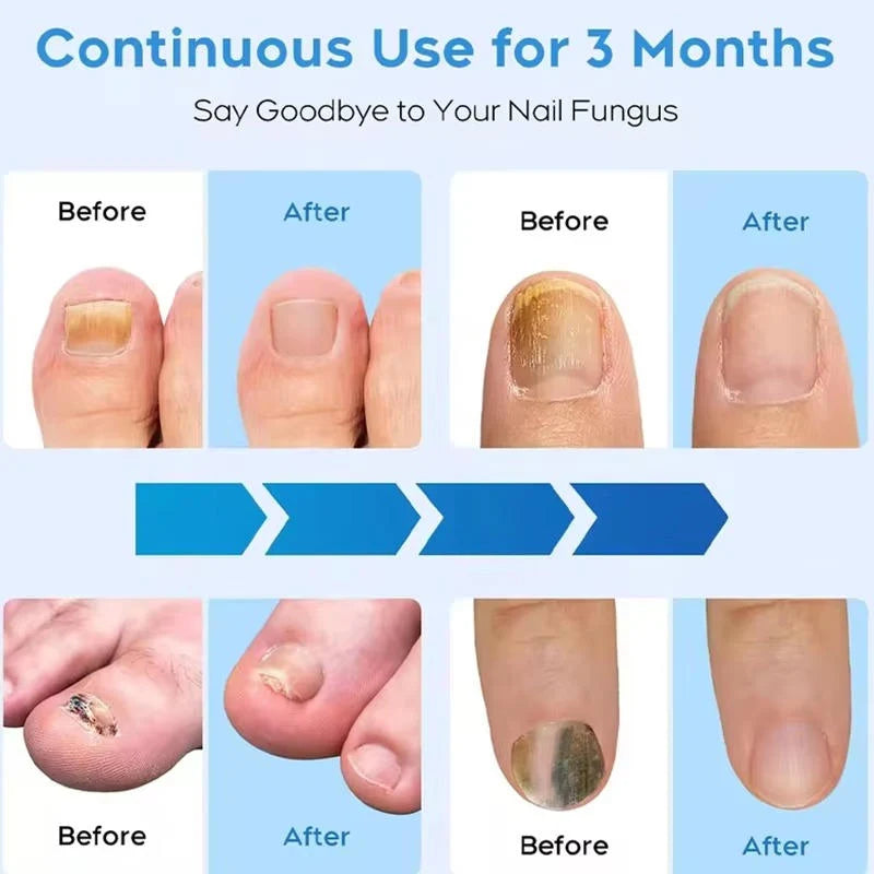 Nail Therapy Device Dual-Wavelength Light Automatic Sensor