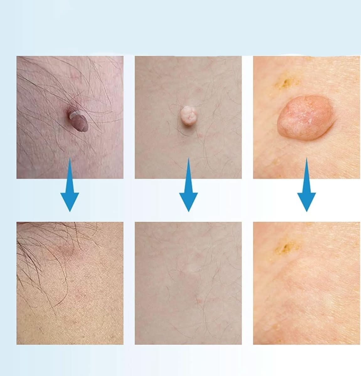 Skin Spot Remover Tool – Simple and Effective Care Solution