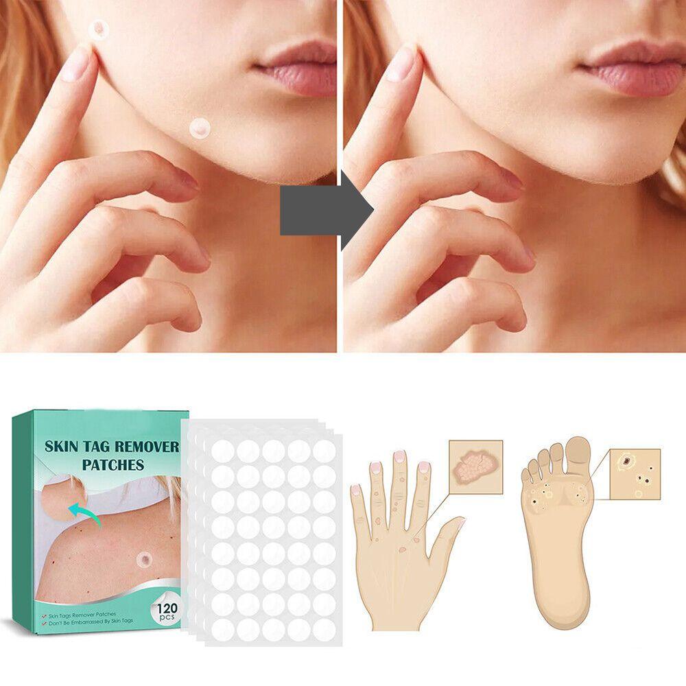 Skin Treatment Patches for Spot and Wart Removal – Discreet Design