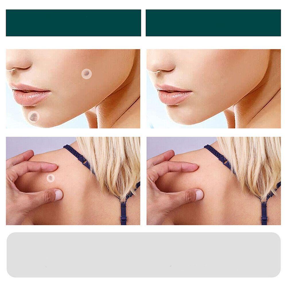Skin Treatment Patches for Spot and Wart Removal – Discreet Design