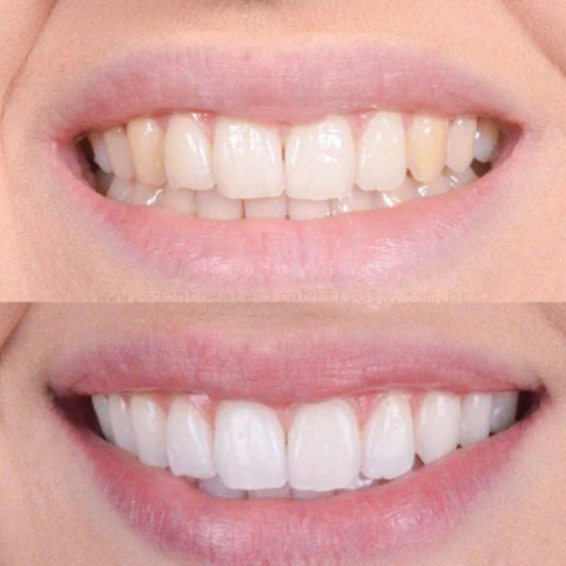 LumaBeam™ — Transform Your Smile Instantly for Unstoppable Confidence
