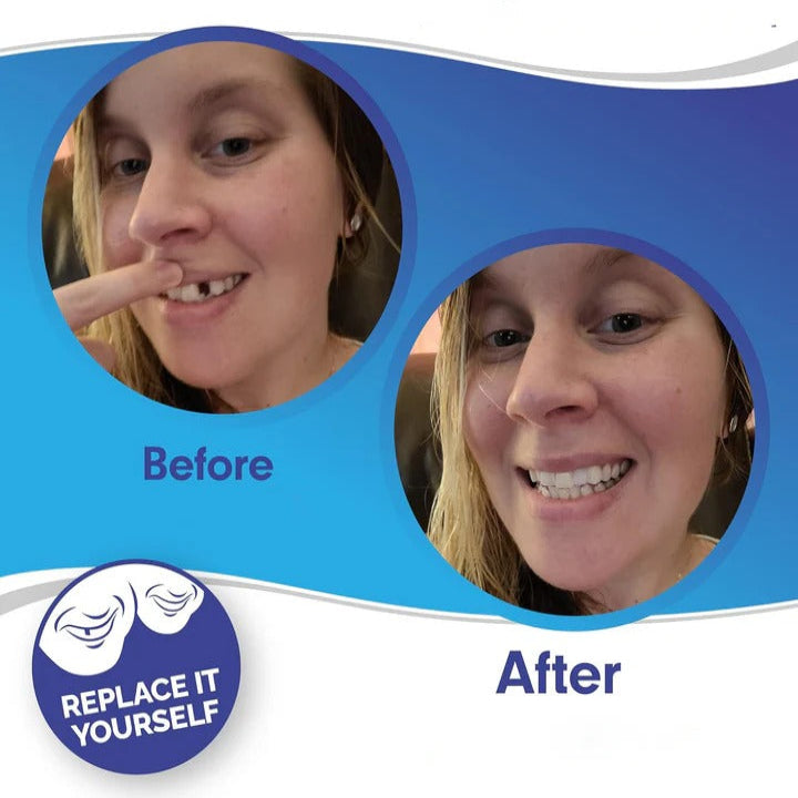 Teeth Veneer Set for Upper and Lower Coverage - Clip-On Design