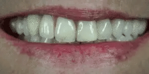 Removable Smile Cover Snap-On Veneers for Top and Bottom Teeth