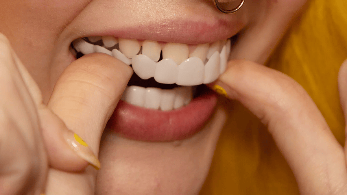 Removable Smile Cover Snap-On Veneers for Top and Bottom Teeth