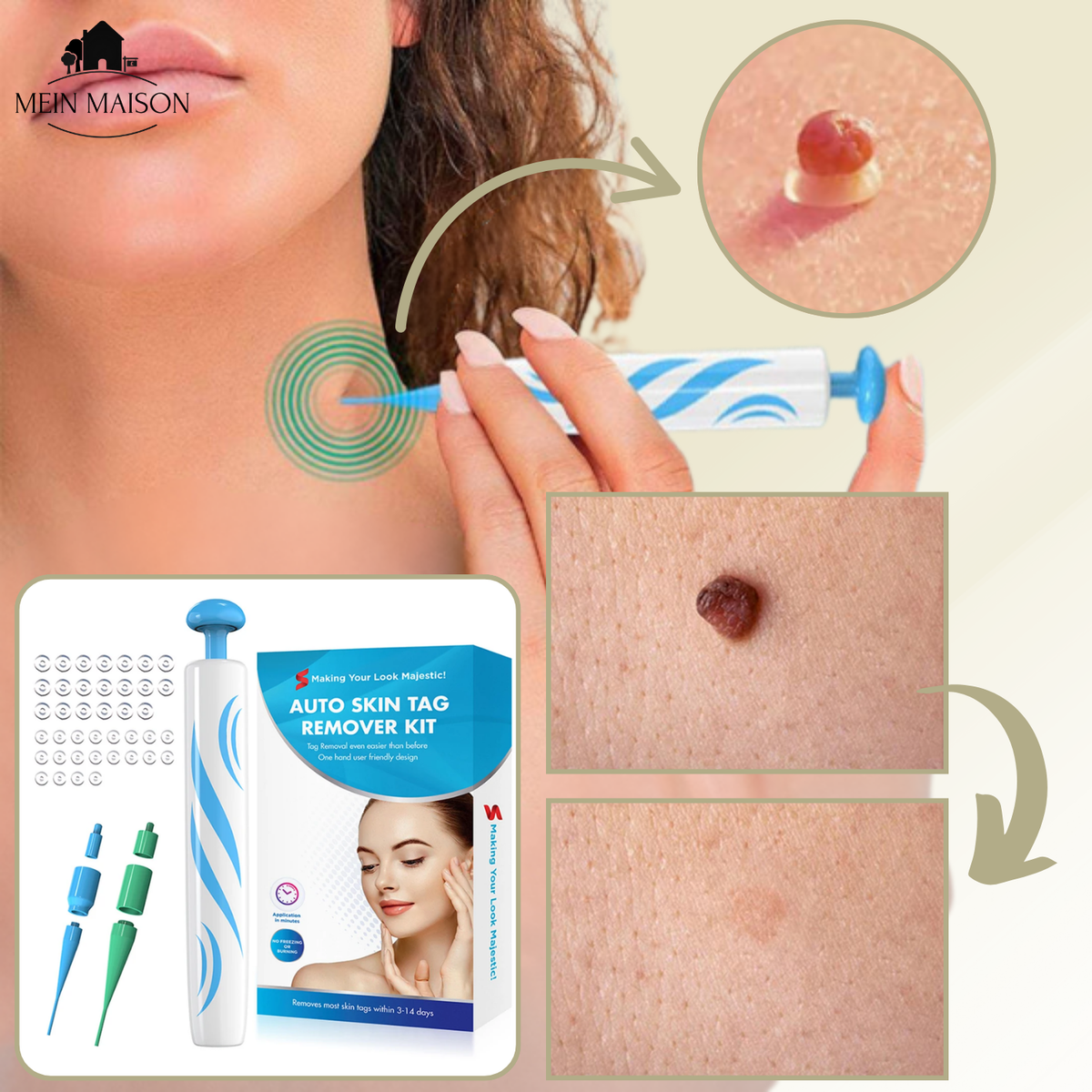 Skin Treatment for Wart and Mole Removal at Home Without Pain