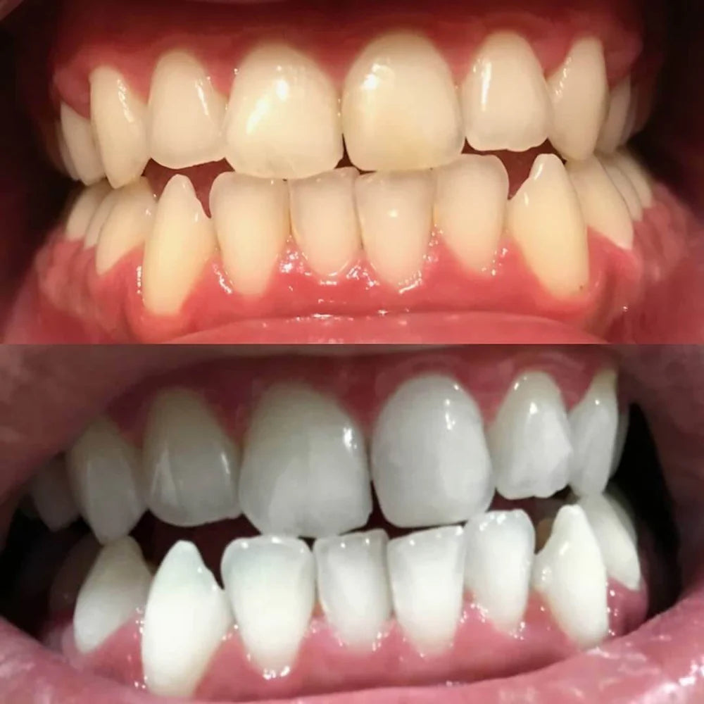 RadianceBeam™ — Ignite Instant Confidence with a Brilliant, Pain-Free Smile