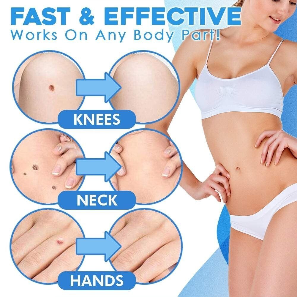 CircuLuxe™ — Pain-Free Skin Tag Removal for Instant Confidence and Clear, Radiant Skin