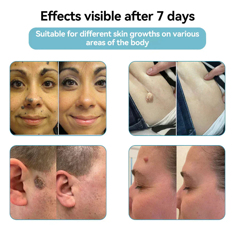 CO₂ Technology Laser Pen for Treating Skin Imperfections