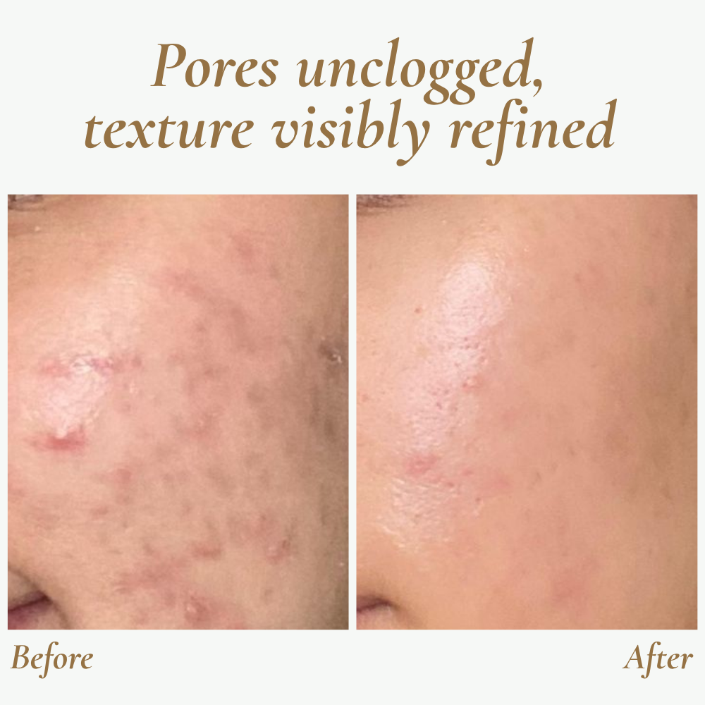 Ultrasonic Skin Cleanser for Professional Use - SkinPulse Device