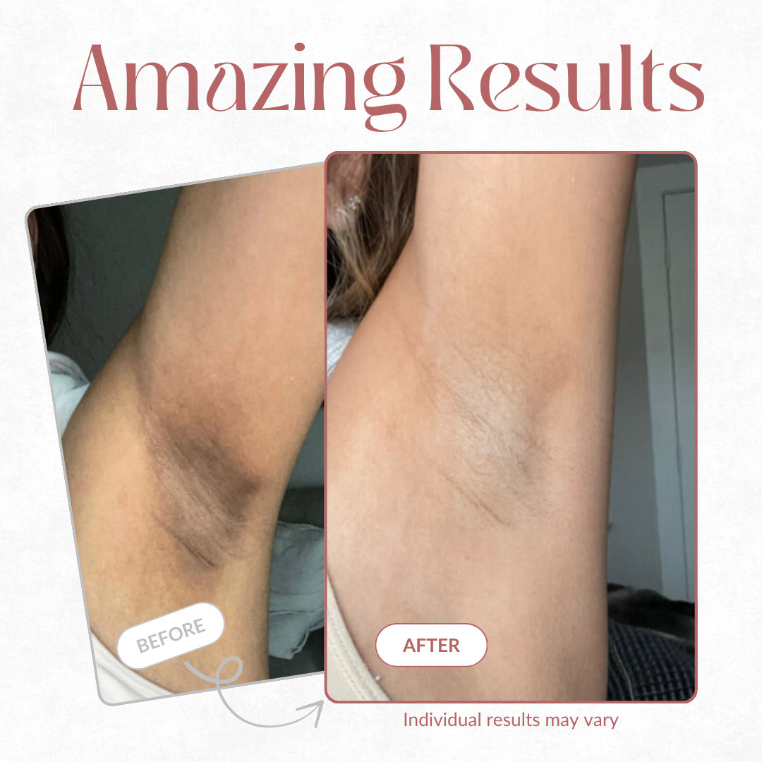 LumiDerm™ Body Peel — Reveal Silky Smooth, Radiant Skin You’ll Proudly Show Off
