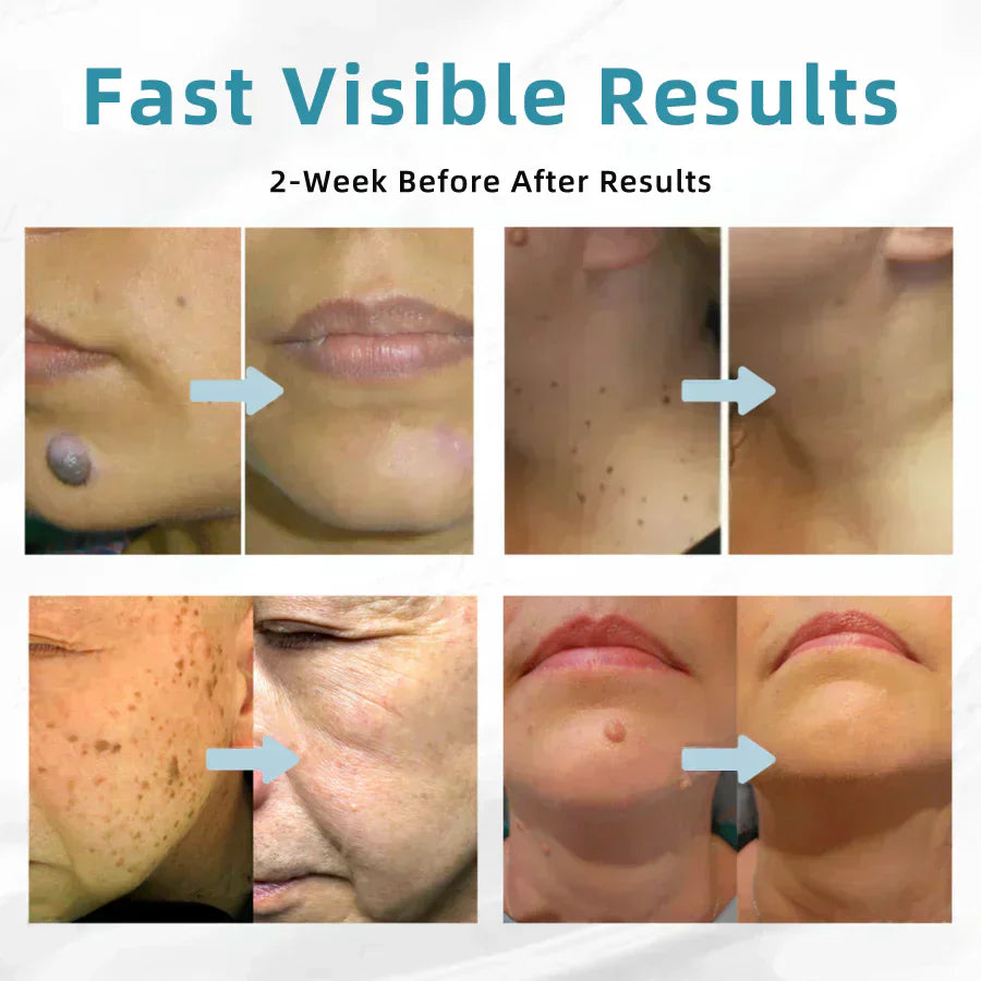 CO₂ Technology Laser Pen for Treating Skin Imperfections