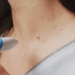 Skin Tag Eliminator Set - Effortlessly Restore Smooth Skin