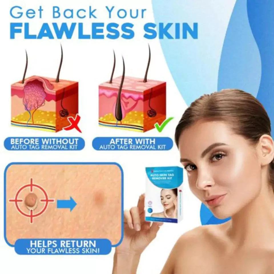 Skin Tag Removal Kit for Home Use | Targeted Painless Tool