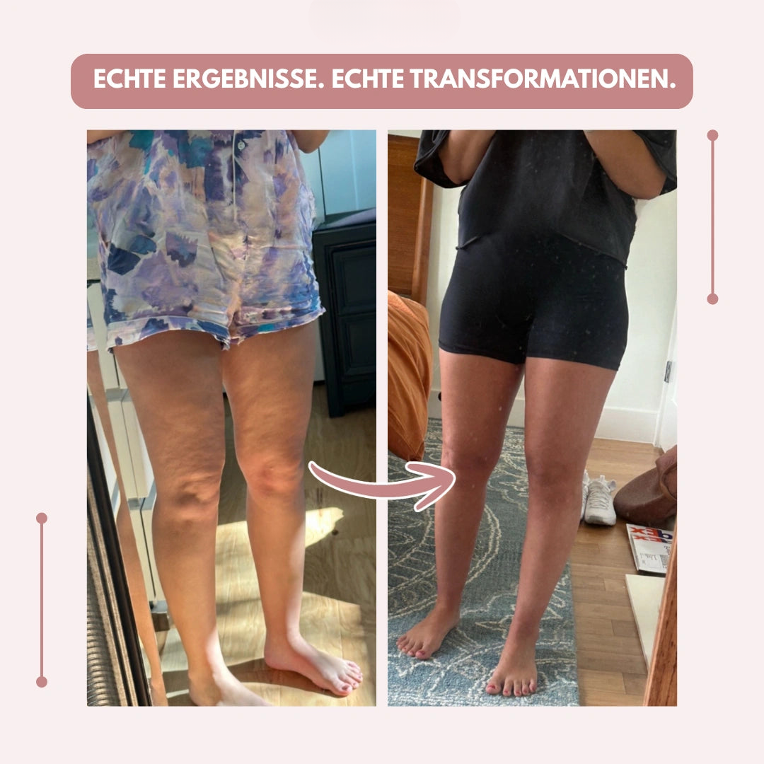 High-Waisted Compression Leggings for Lipoedema Pain Relief