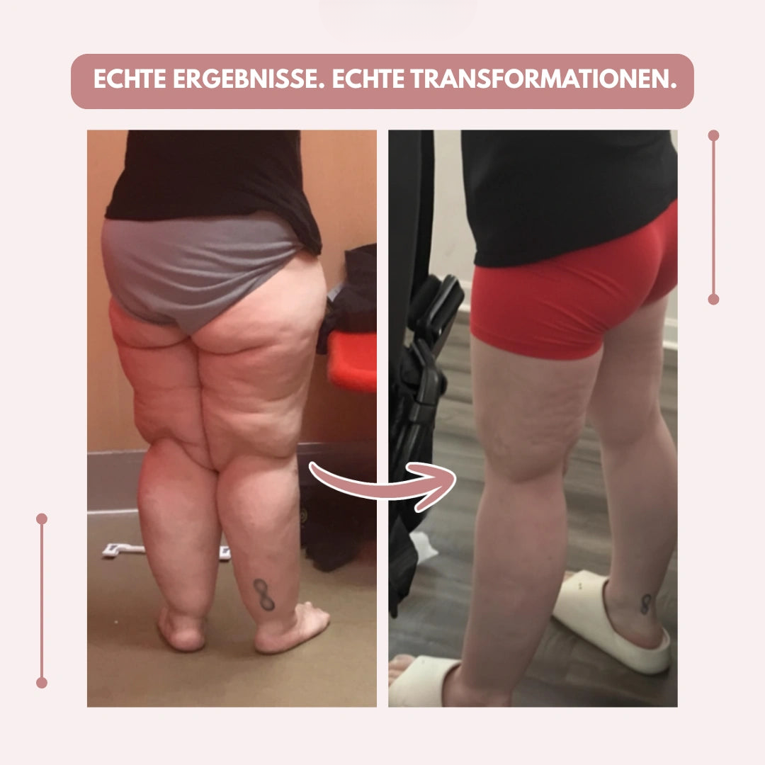 High-Waisted Compression Leggings for Lipoedema Pain Relief