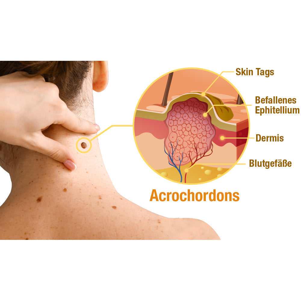 Bee Venom Skin Treatment Spray for Spots and Warts | Suitable for All Skin Types