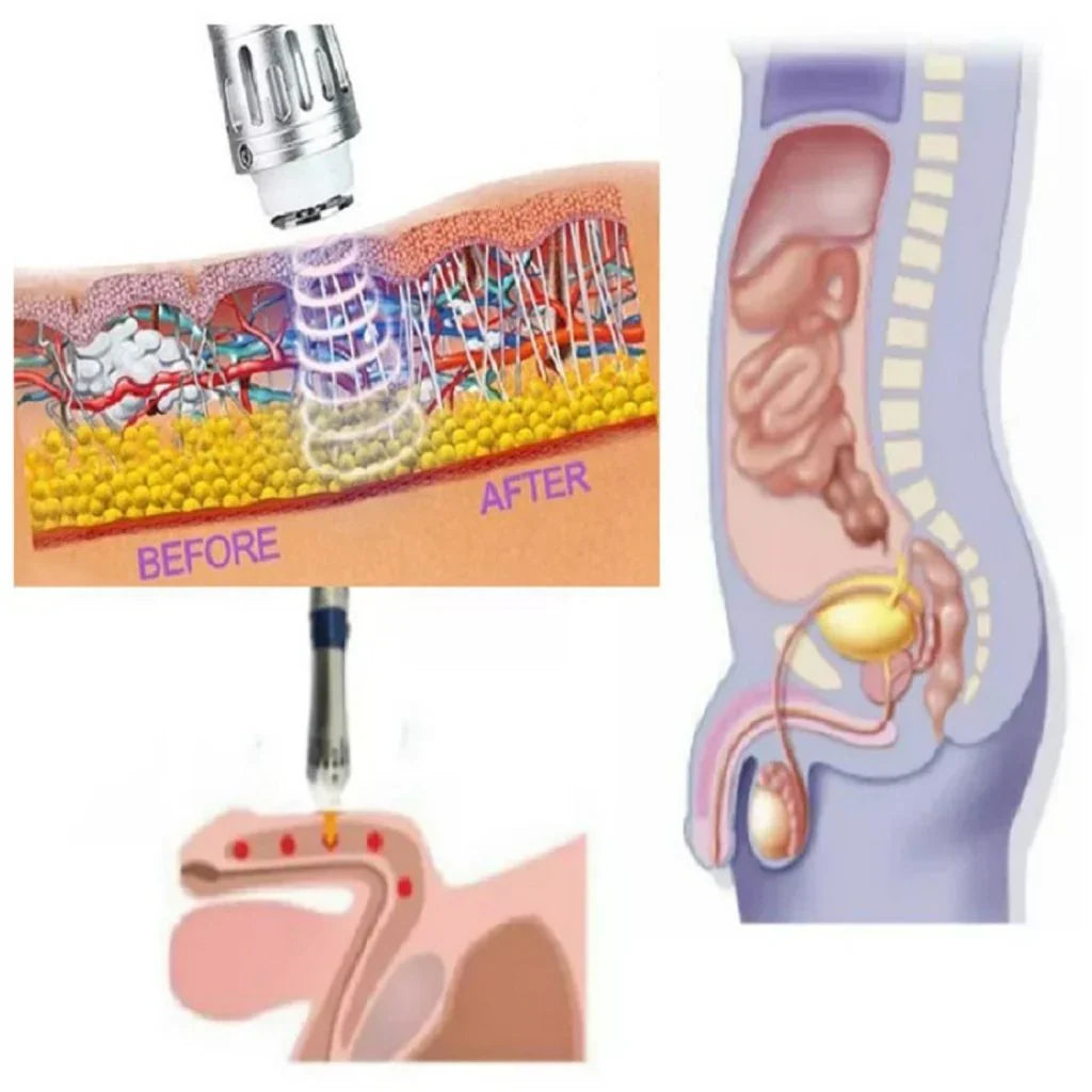 Compact Shockwave Therapy Device for Enhanced Male Wellness
