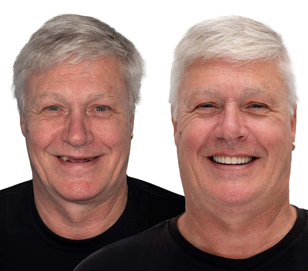 Cosmetic Denture Set Moldable Upper & Lower At-Home Fit