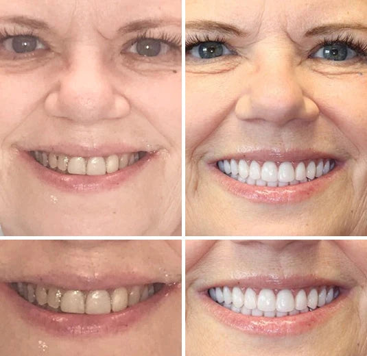 Denture Set Moldable Custom Fit Upper & Lower