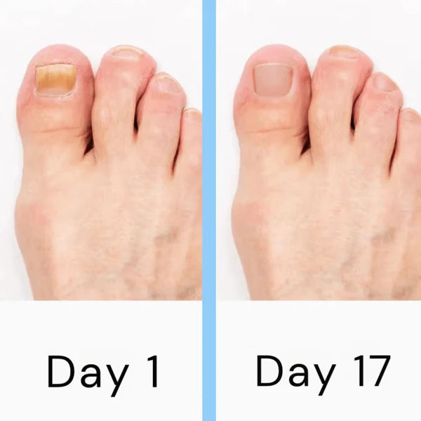 Nail Fungus Light Therapy Device Dual-Wavelength LED