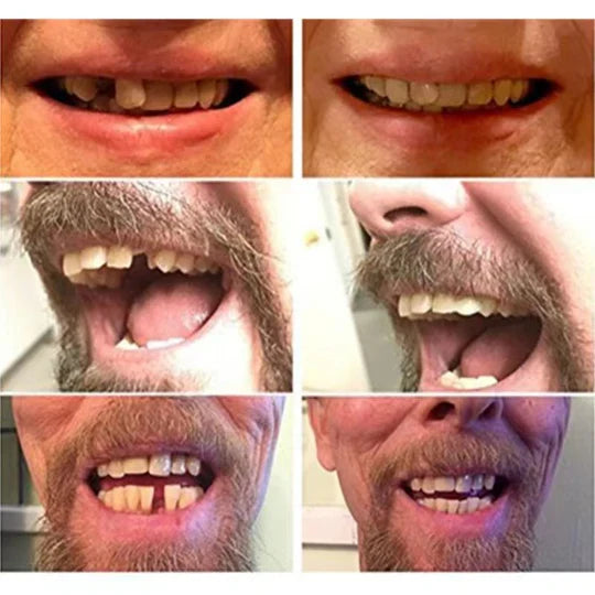 Temporary Veneers Natural Look & Comfortable Fit