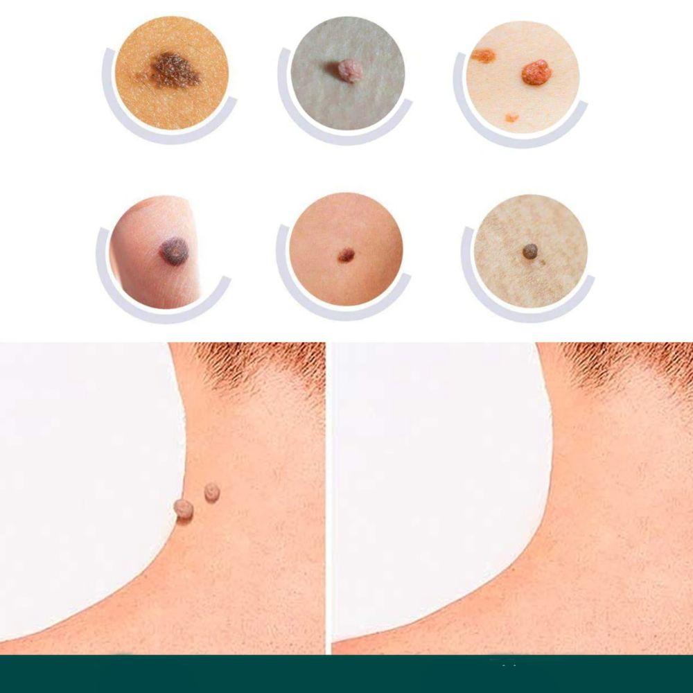 Skin Treatment Patches for Spot and Wart Removal – Discreet Design