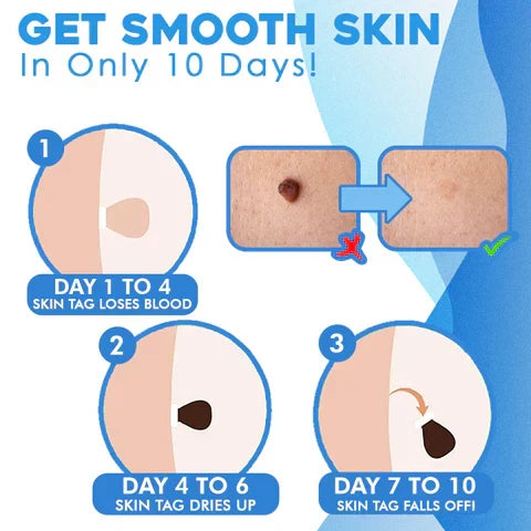 Skin Tag Removal Kit for Home Use | Targeted Painless Tool