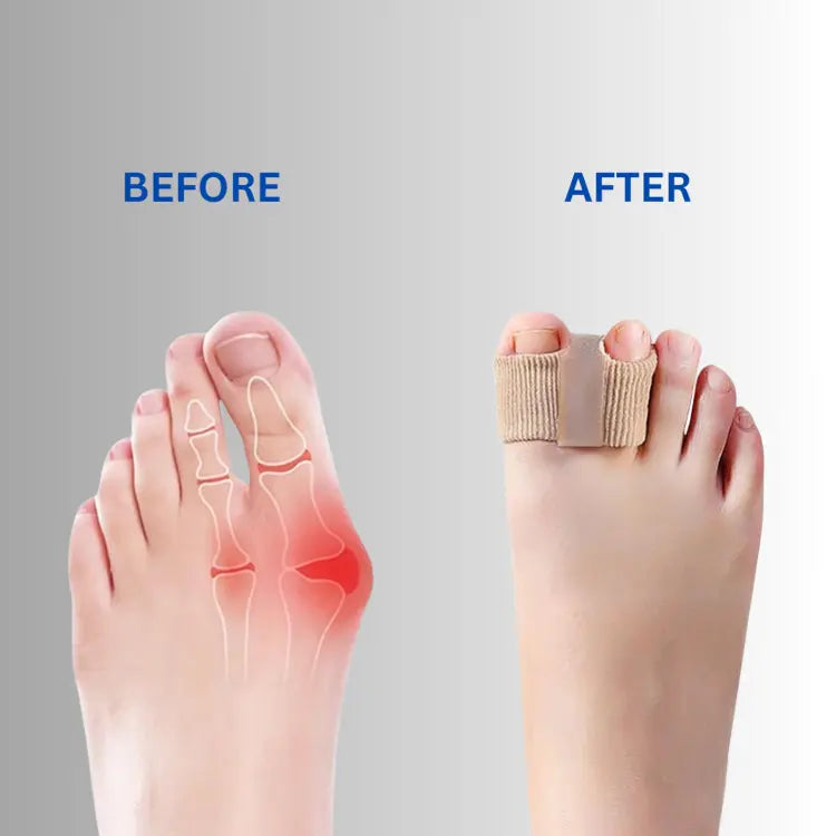 Bunion Corrector and Toe Separator – Aligner for Overlapping Toes