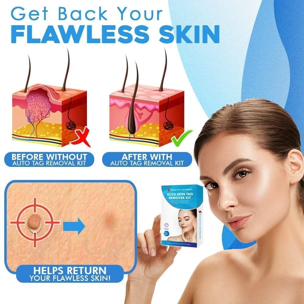 CircuLuxe™ — Pain-Free Skin Tag Removal for Instant Confidence and Clear, Radiant Skin