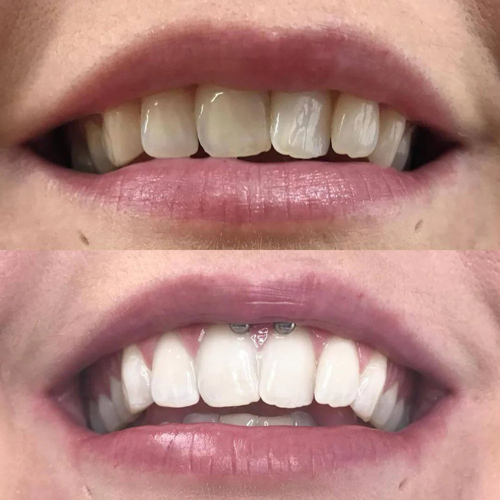 RadianceBeam™ — Ignite Instant Confidence with a Brilliant, Pain-Free Smile
