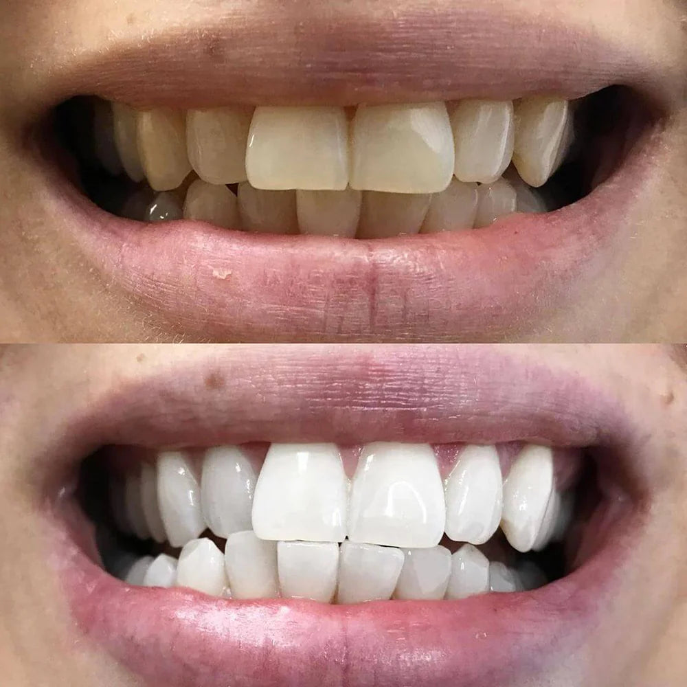 RadianceBeam™ — Ignite Instant Confidence with a Brilliant, Pain-Free Smile