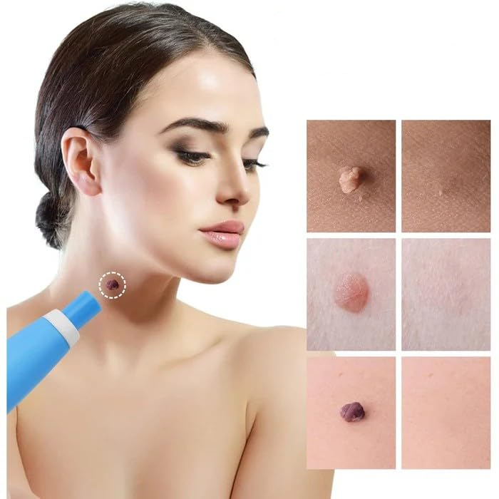 Painless Skin Spot Removal Set – No Need for Doctor's Appointment