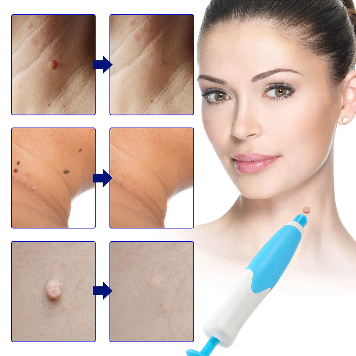 Painless Skin Spot Removal Set – No Need for Doctor's Appointment