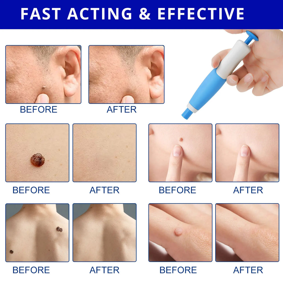 Painless Skin Spot Removal Set – No Need for Doctor's Appointment