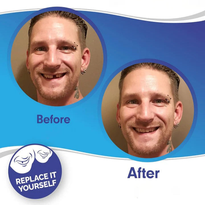 Teeth Veneer Set for Upper and Lower Coverage - Clip-On Design
