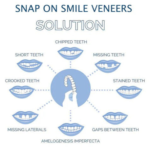 Teeth Veneer Set for Upper and Lower Coverage - Clip-On Design