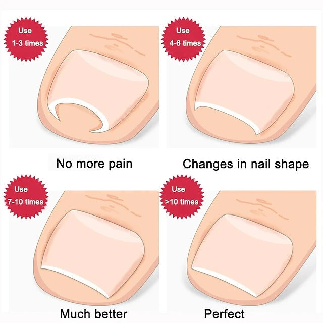 Stainless Steel Nail Care Set - 2 Toenail Correction Clips with Straightener