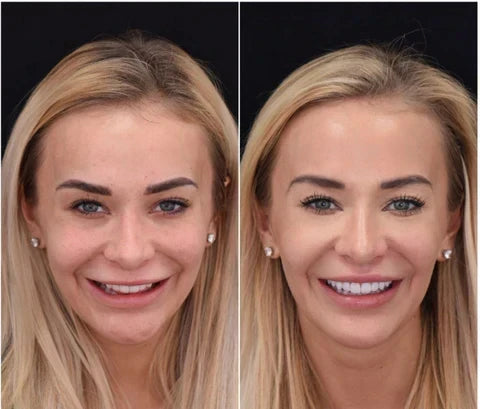 Removable Smile Cover Snap-On Veneers for Top and Bottom Teeth