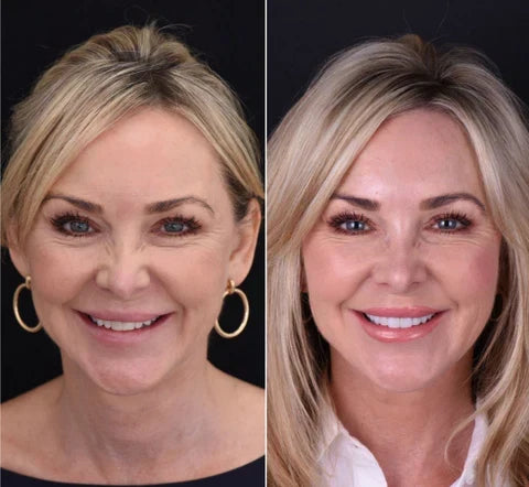 Removable Smile Cover Snap-On Veneers for Top and Bottom Teeth