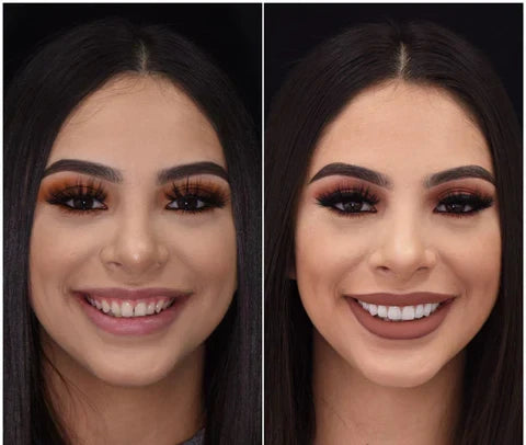 Removable Smile Cover Snap-On Veneers for Top and Bottom Teeth
